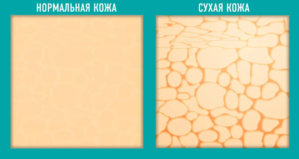 сухая кожа у девушек сухая кожа у девушек